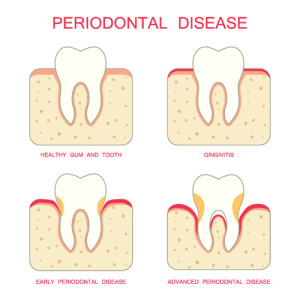 periodontal-disease